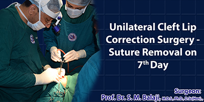 Unilateral Cleft Lip Correction Surgery – Suture Removal on 7th day