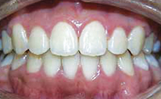 Dental Braces After Treatment