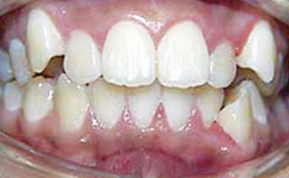 Dental Braces Before Treatment