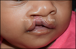 Incomplete Cleft Lip In A 3 Months Old Baby Girl