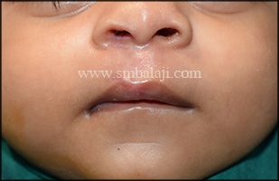 Immediately After Suture Removal Following Seven Days Of Surgery Showing Enhanced Appearance