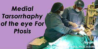 Medial Tarsorrhaphy of the eye for Ptosis