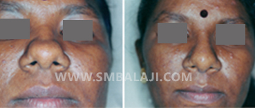 Broad Nose Repair 2 Nasal Correction Surgery For A Bulky Nose