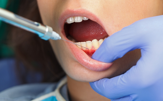Root Canal Treatment 3 Numbing The Tooth By Local Anesthesia