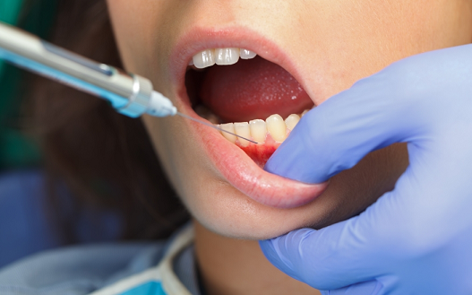 Numbing The Tooth By Local Anesthesia