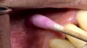 Root Canal Treatment 2 Numbing The Tooth For Root Canal Treatment