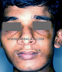 Parry-Romberg Syndrome 2 Appearance Enhanced After Fat Graft Surgery