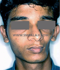 Parry-Romberg Syndrome 1 Facial Tissue Atrophy On Left Side Of The Face