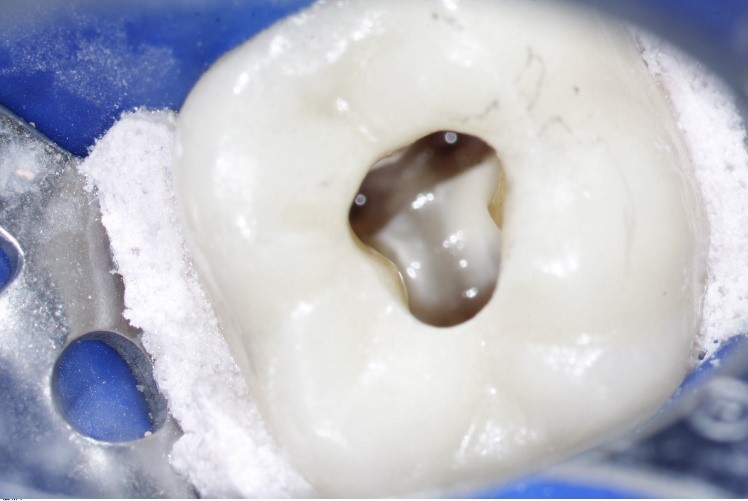 Pulp Of The Tooth Root Canal Treatment