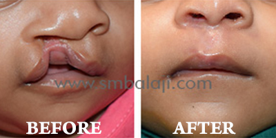 Cleft Lip and palate Surgery, India