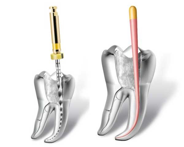 Root Canal Treatment 5 Root Filling Rct