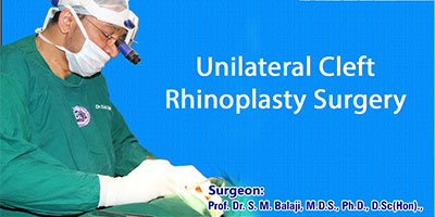 Unilateral Cleft Rhinoplasty Surgery