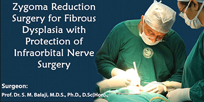 Zygoma Reduction Surgery for Fibrous dysplasia