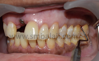 Furcation Defect 1 After Oral Prophylaxis And Sub-Gingival Debridement The Surgical Procedure Was Planned