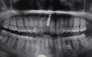 Furcation Defect 2 Opg Reveals Horizontal Bone Loss Irt 26 27 Region