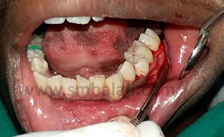 After Phase I Therapy, Full Thickness Mucoperiosteal Flap Was Elevated Till Mucogingival Junction Irt 35 36 37 Region Under Local Anesthesia