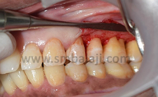 Furcation Defect 3 Full Thickness Mucoperiosteal Flap Elevated
