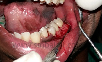 Vertical Decortications Are Given Along The Buccal Aspect Extending 2 To 3Mm Below The Crest Of The Bone To A Point 2Mm Beyond The Apices Of The Roots