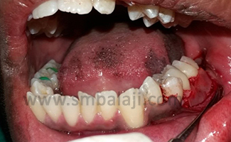 Gtr Membrane Was Placed Over The Bone Graft Other Material Of Choice Will Include Prf, Prp, Growth Factors