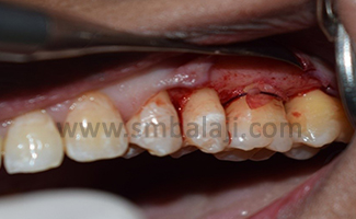 Furcation Defect 5 5 Gtr Membrane Placed Over The Furcation Defect