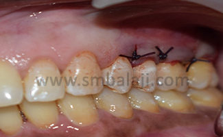 Furcation Defect 6 Mucoperiosteal Flap Approximated To Cover The Gingival Recession. Suturing Done Using 3.0 Vicryl