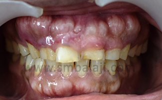 Bony Mass Exostosis Evident In Maxilla And Mandible