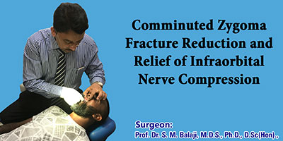 Comminuted zygoma fracture reduction and relief of infraorbital nerve compression