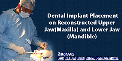 Dental Implant Placement on Reconstructed Upper Jaw(Maxilla) and Lower Jaw (Mandible)