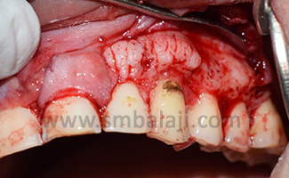 Exposure Of Bony Mass After Flap Elevation