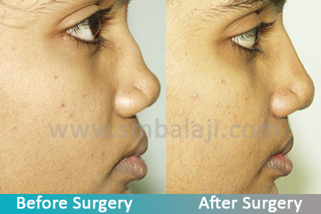 Flat Nose Repair 2 Flat Nose Repair Rhinoplasty Surgeon In India