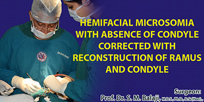 Hemifacial Microsomia and Microtia with absence of condyle corrected with reconstruction of ramus and condyle