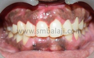 Gingival Enlargements 2 Post-Operative View Showing Esthetically Pleasing Gingival Contour