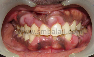 Gingival Enlargements 1 Pre-Operative View Showing Plaque Induced Gingival Enlargement