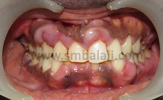 Pre-Operative View Showing Plaque Induced Gingival Enlargement