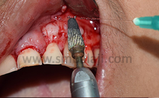 Trimming Of Bony Mass