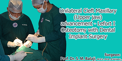 Unilateral Cleft Maxillary advancement LeFort I Osteotomy with Dental Implant