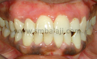 After Gum Treatment