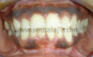 Depigmentation of Gingiva 1 Before Gum Treatmentt