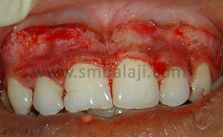 Depigmentation of Gingiva 2 During Gum Surgery