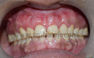Buccal Exostosis / Tori (Bony Enlargement) Correction 4 Maxilla Following Surgical Excision Of Bony Mass