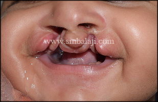 Bilateral Cleft Lip And Palate Defect In 3 Months Old Baby Boy