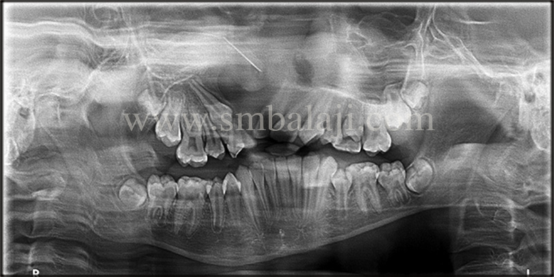 Opg Showing The Wide Unilateral Alveolar Cleft Defect