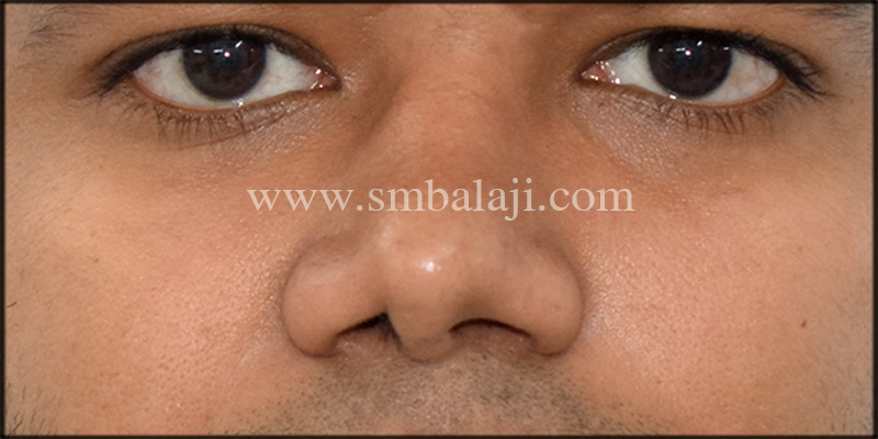 Pre-operative view showing deviated and depressed nasal bridge