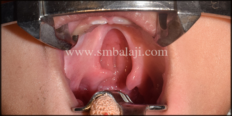 Pre-Operative View Showing Isolated Cleft Palate