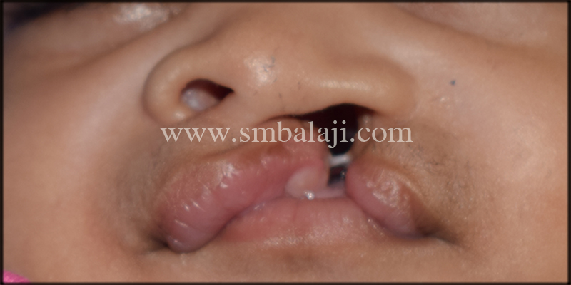 Unilateral Cleft Lip And Palate Defect In 3 Months Old Baby Girl