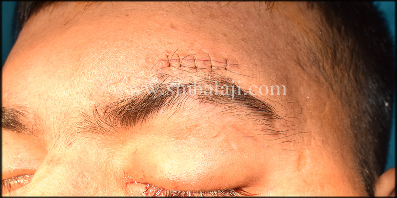 Immediately After Suturing Showing Corrected Left Eyebrow Defect