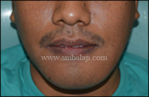 Preoperative Facial Profile Showing Huge Swelling In The Lower Half Of The Face