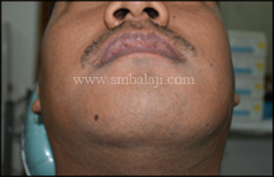 Preoperative facial view showing huge swelling in the lower half of the face