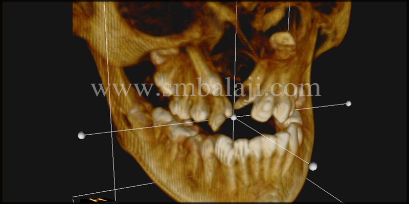 3D Cbct Scan Showing The Wide Unilateral Alveolar Cleft Defect