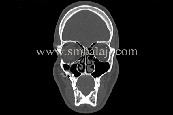 Ct Scan Showing Herniation Of The Right Orbital Contents